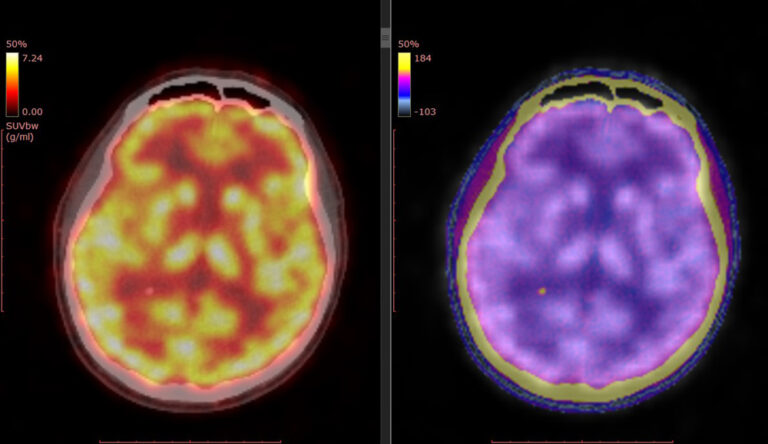 Pet,Ct,Scan,Of,Human,Brain,(axial,View,Positron,Emission