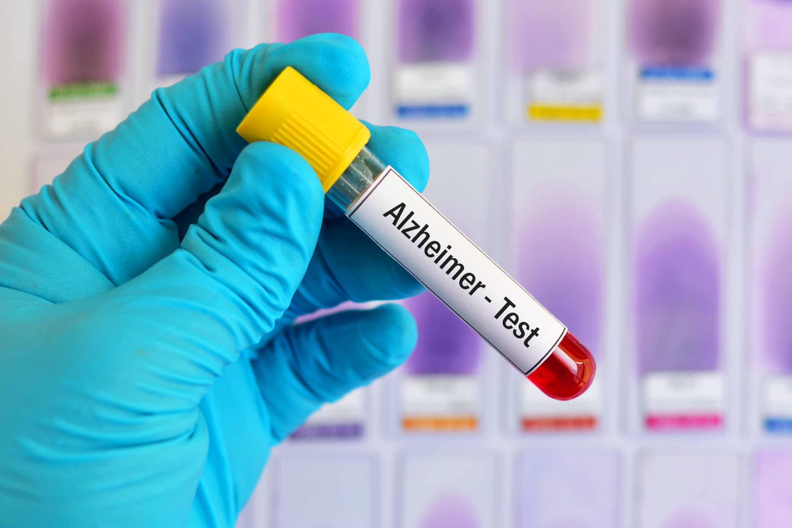 New Alzheimer’s Blood Test Flags Symptom Onset